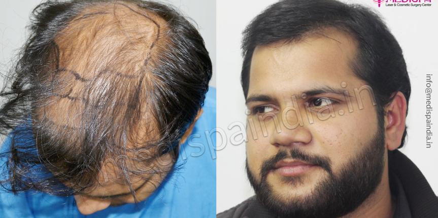 hair transplant cost Hyderabad