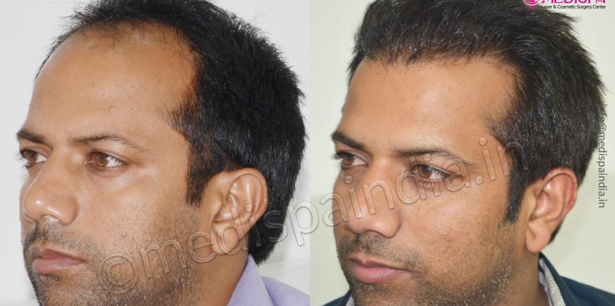 hair transplant surgeons in gurugram