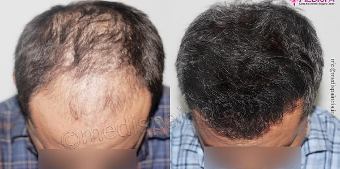 Tips To Avoid Side Effects After Hair Restoration Surgery