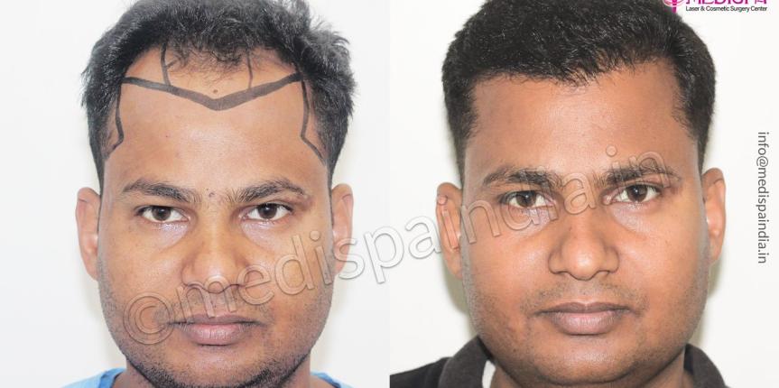 hair transplant Hyderabad results