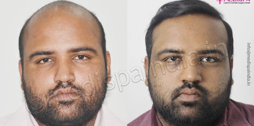 hair transplant in gurgaon