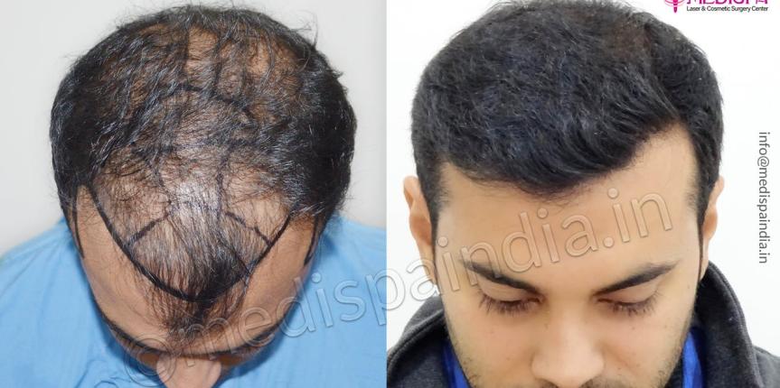 hair transplant clinics in jaipur rajasthan