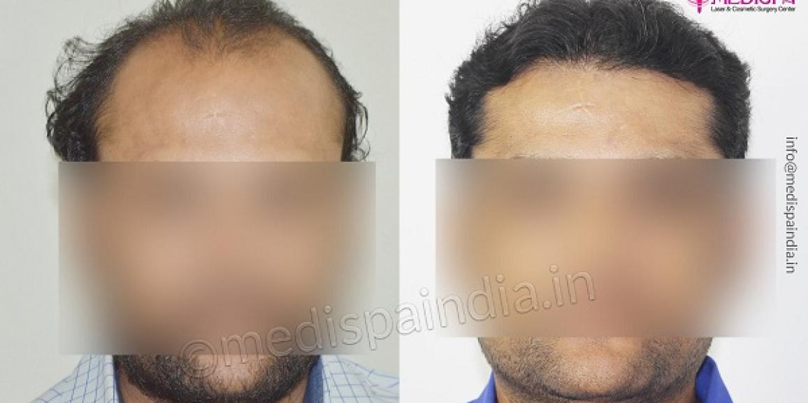 How Does Hair Transplant Help In Enhancing Your Appearance?