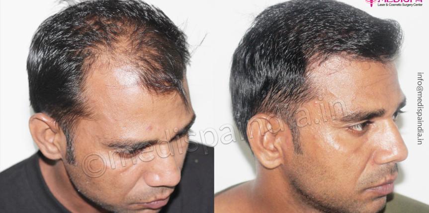 hair transplant before after result india