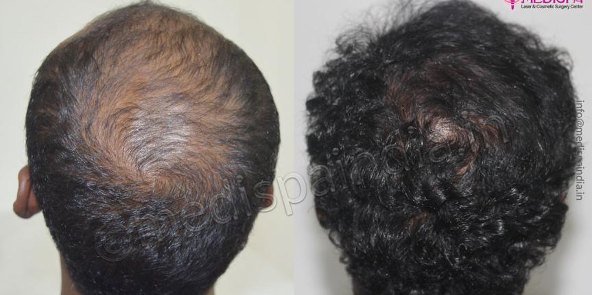 hair transplant surgeons in bengaluru