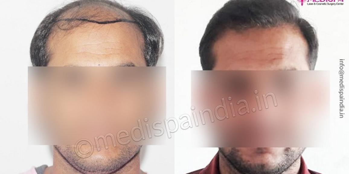 Before And After Hair Transplant – Step By Step Guide