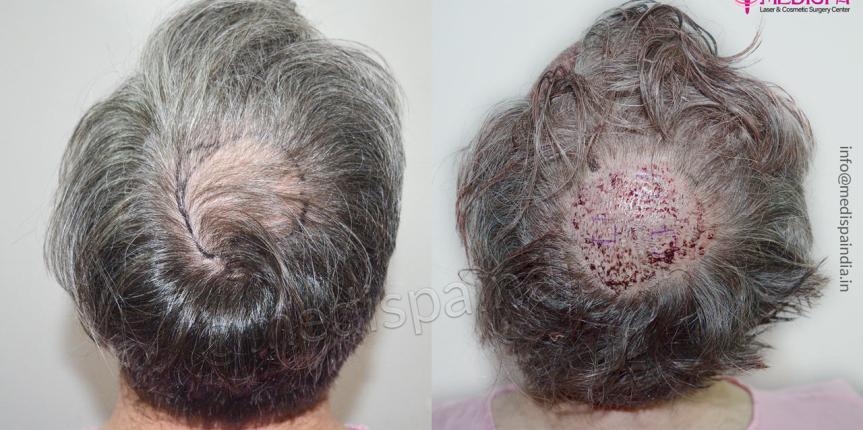best hair transplant uk results
