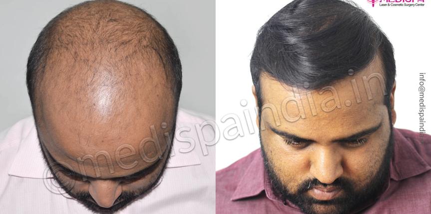 hair transplant cost in gurgaon