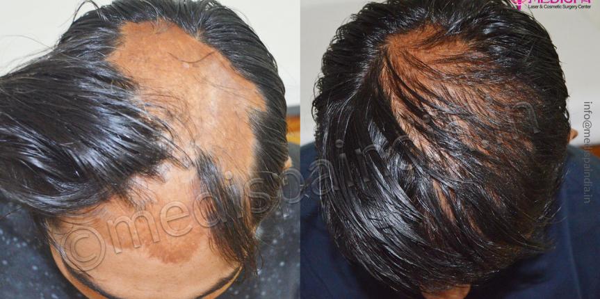 burn hair transplant jaipur