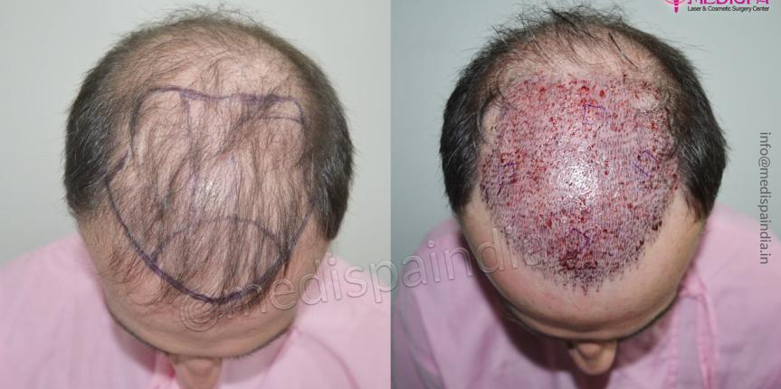 hair transplant ireland before after