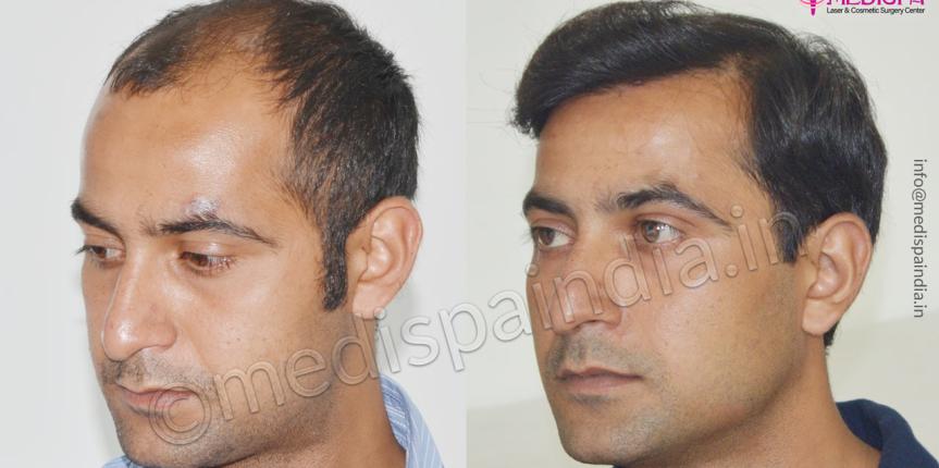 best hair transplant clinics in india