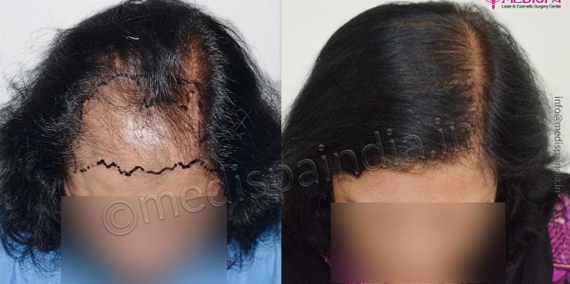 Facts You Must Know About Female Hair Transplant