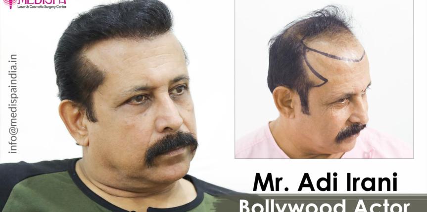 celebrity-hair-transplant-adi-irani