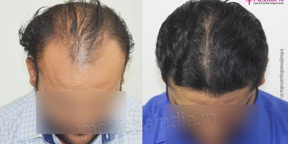 Which is The Best Hair Transplant Method For High Grade Baldness?