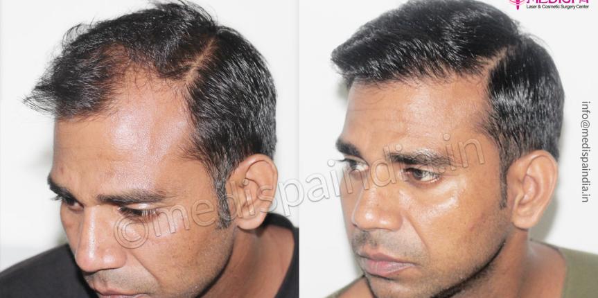 hair restoration before after results