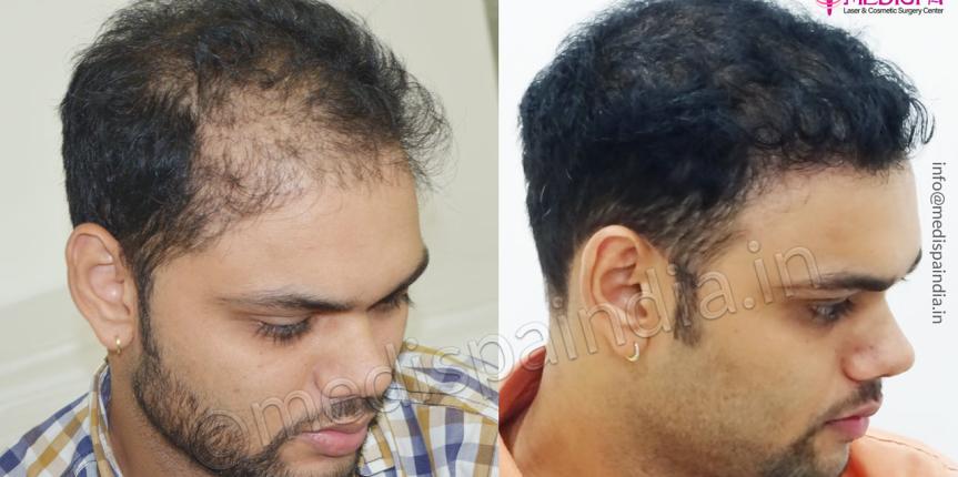wrong hair transplant correction bangalore
