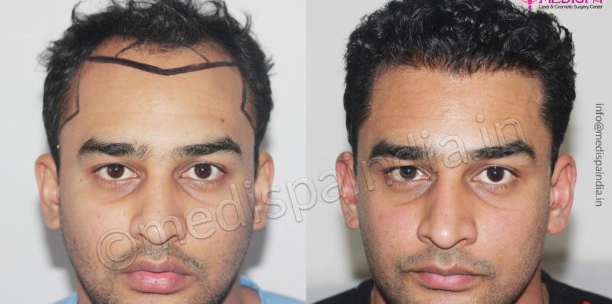cost of hair transplant results