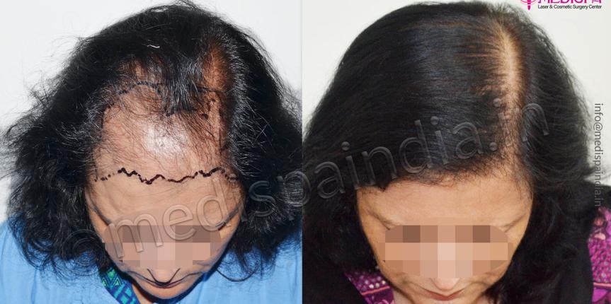 hair transplant doctors in greater kailash south delhi