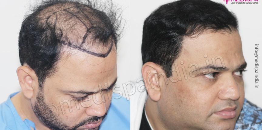 hair transplant clinics in hyderabad