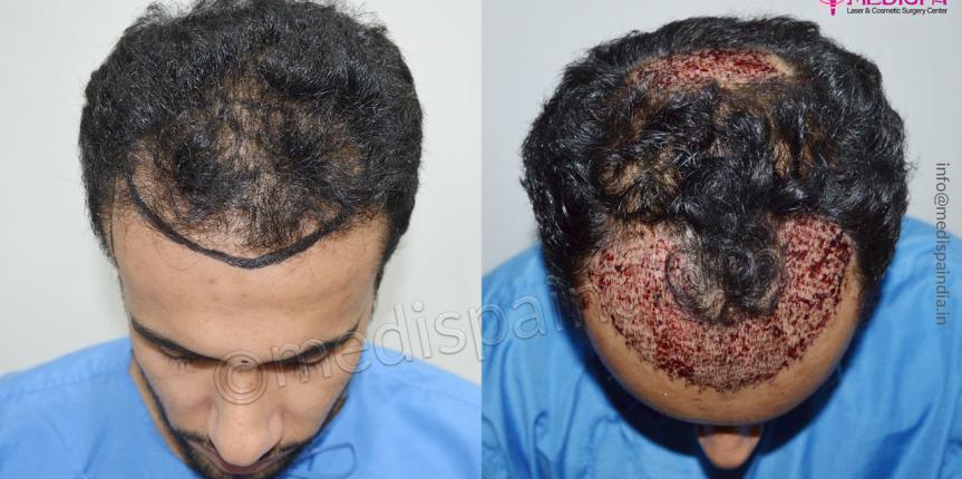 hair transplant before and after dubai