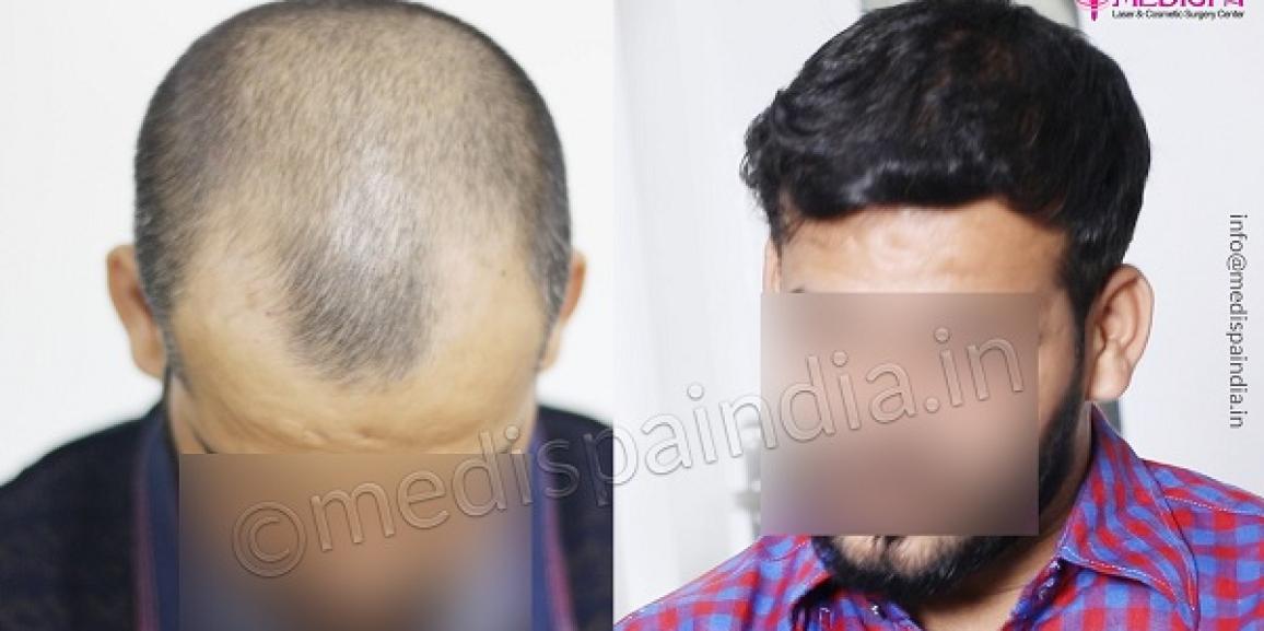 What are The Factors That Determine Appropriate Hair Transplant Technique