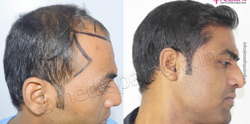 fut fue hair transplant delhi india