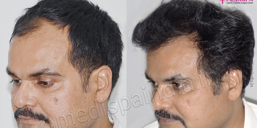 hair transplant after 6 months
