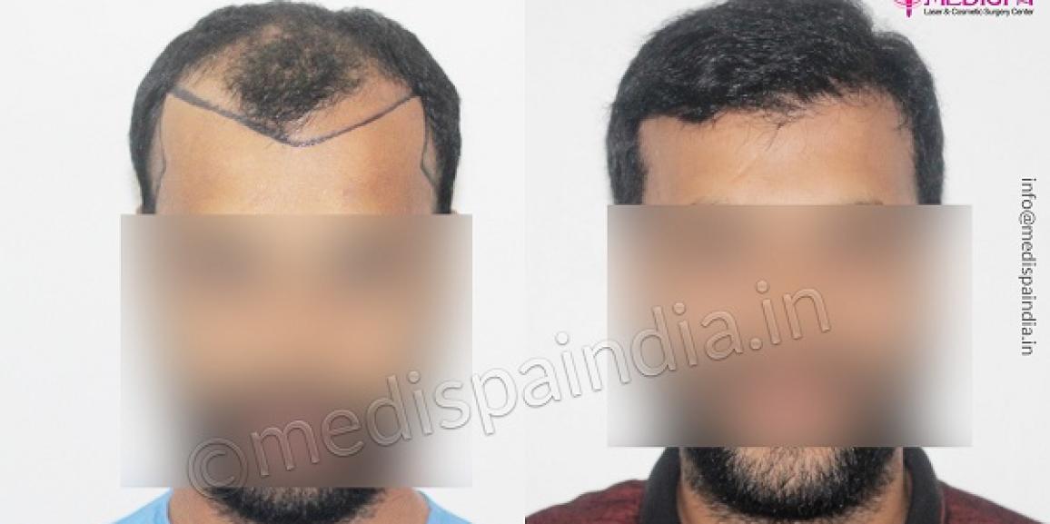 Is It Possible To Get Hair Transplant Surgery Without Scars?