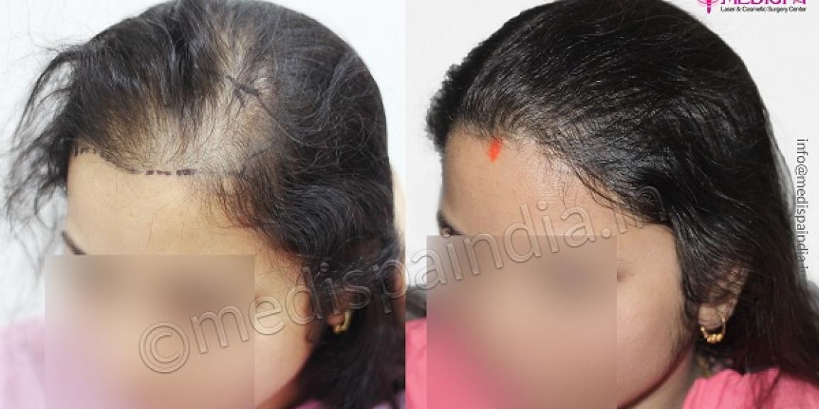 What is The Success Rate For Hair Transplant in Women?