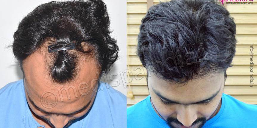 top hair transplant clinics in mumbai