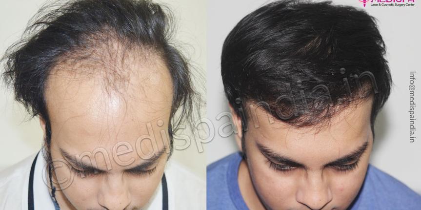 hair transplant clinics in jodhpur