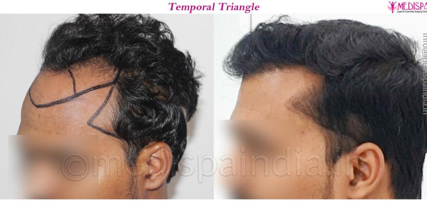 hair-transplant-hairline-design