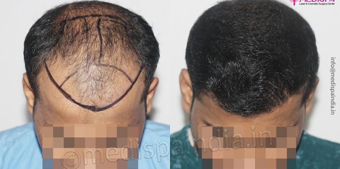 Explain The Importance of Graft in Hair Transplantation