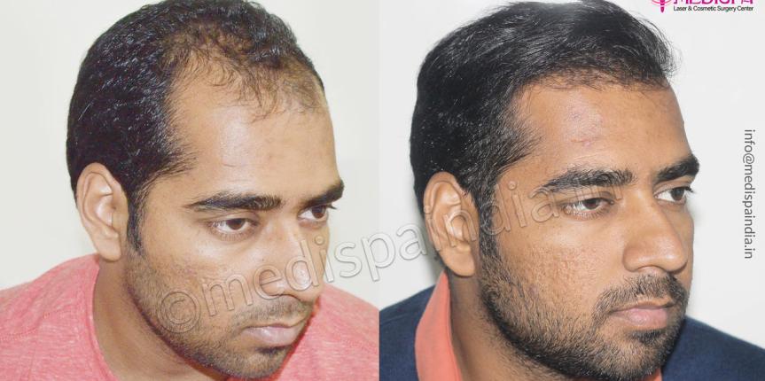 best hair transplant results in india