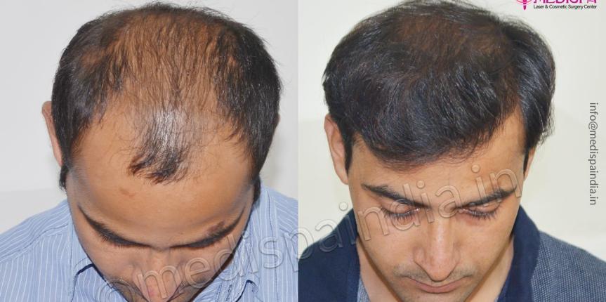 hair transplant clinics in delhi