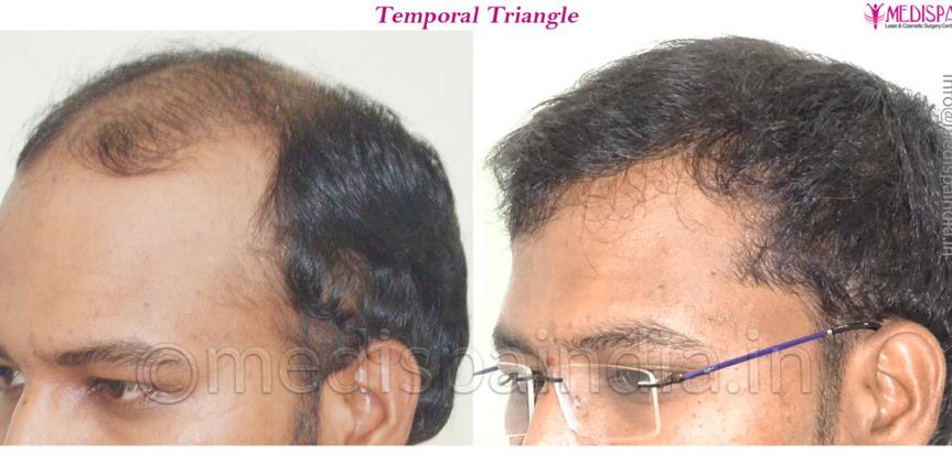 hair restoration cost bangalore