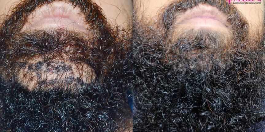 beard hair transplant before and after india