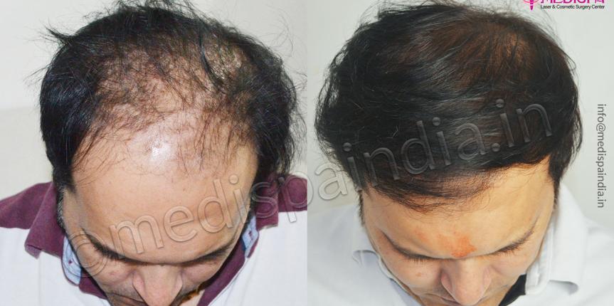 hair transplant in toronto