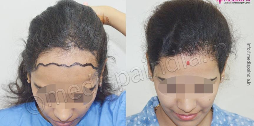 female hair transplant in delhi