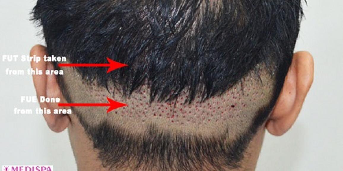 Is FUT+FUE+BHT Combination Hair Transplant Technique Really Effective?
