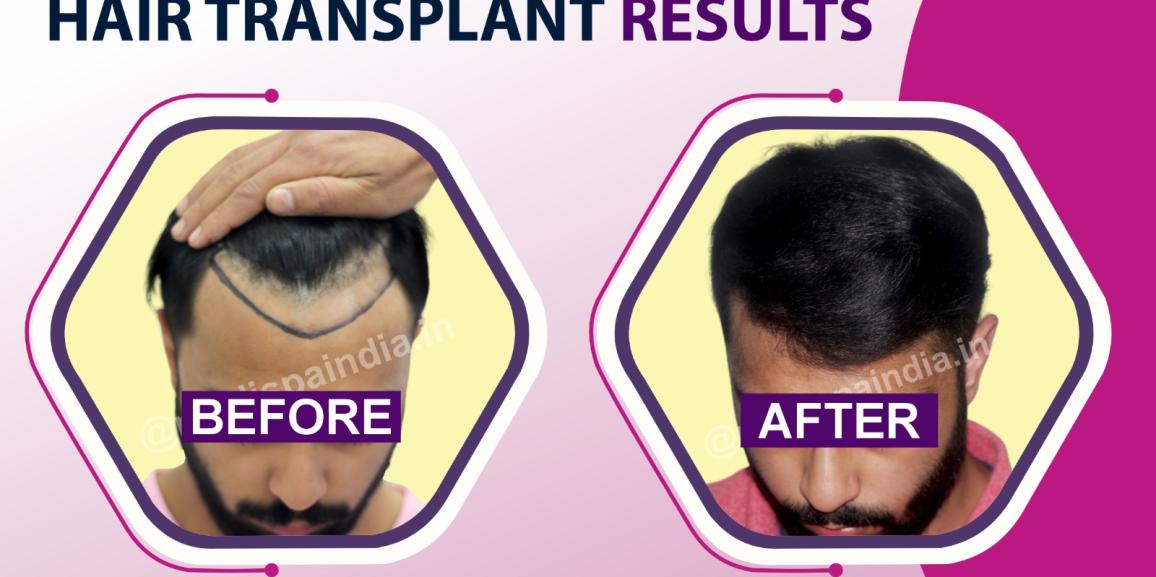 Is Hair Transplant The Best Option To Stop Receding Hairline?