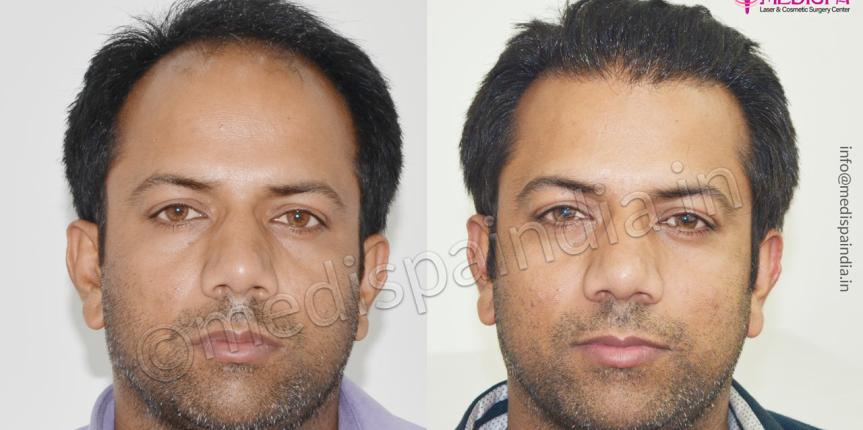 hair transplant in gurugram