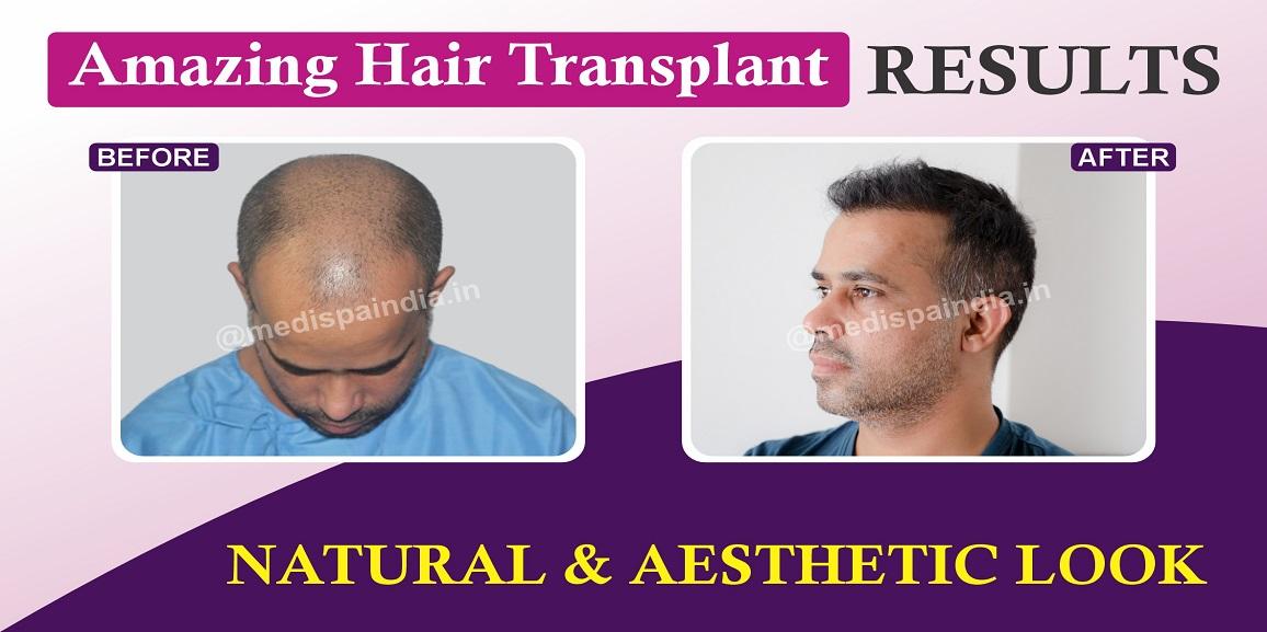 Unlocking Confidence: Explain The Role Of A Skilled Hair Transplant Surgeon