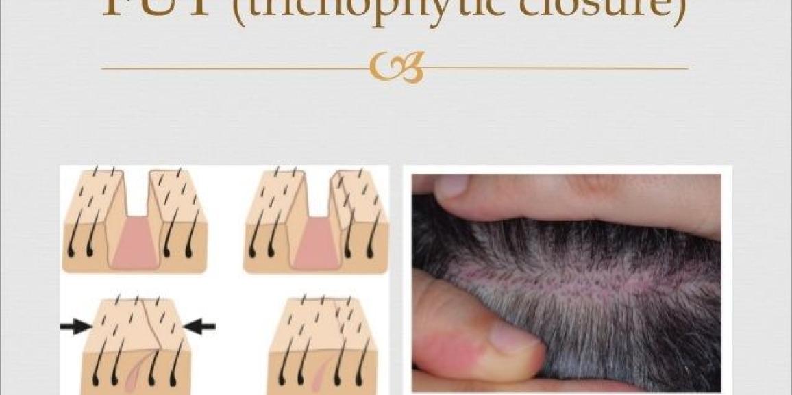 Explain The Significance of Trichophytic Closure in Hair Transplantation