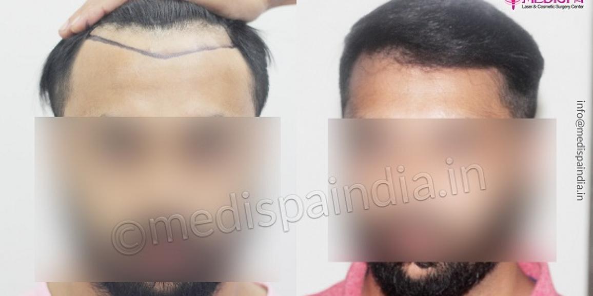 How to overcome male pattern baldness by hair restoration?