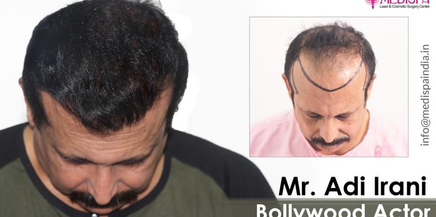 actor-adi-irani-hair-transplant