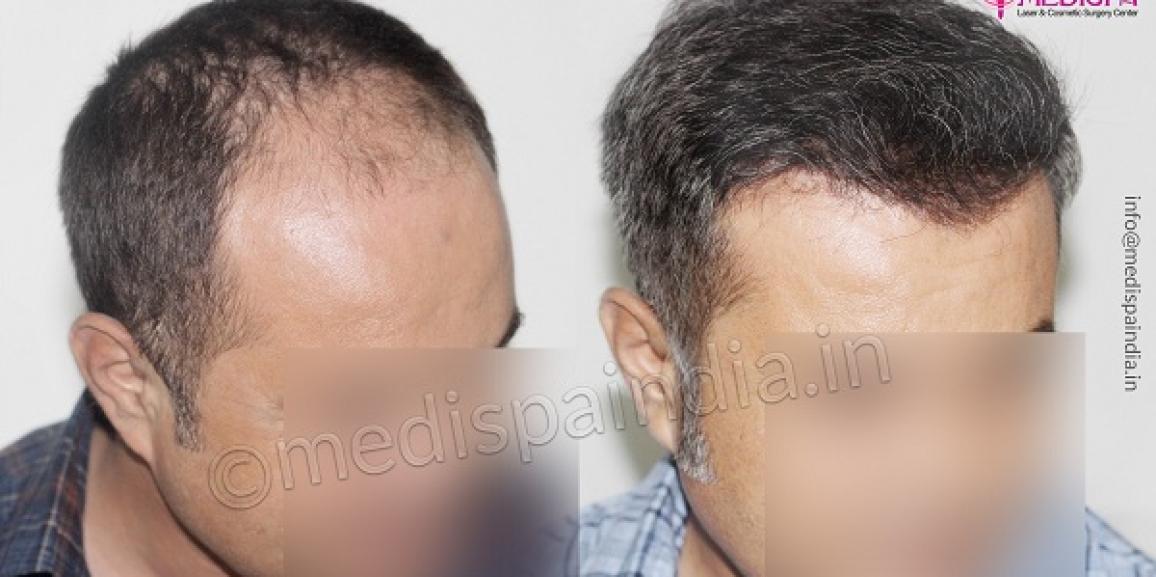 How To Research About The Clinic Before Hair Transplant Surgery?