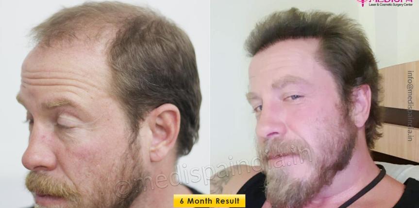 hair transplant before after usa patient