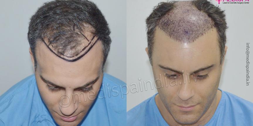 uk hair transplant before after