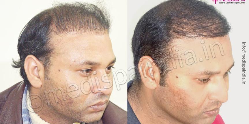 revision hair transplant in india